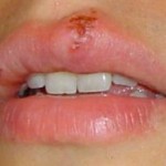 Herpes simplex : cos’è? 