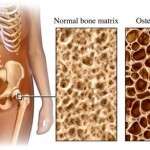 Osteoporosi: come combatterla?