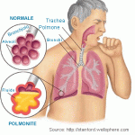 Polmonite: cause, sintomi, cure