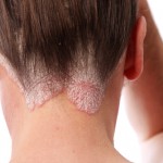 Trattare la psoriasi