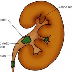 Calcoli renali: sintomi e cure